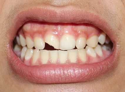 Emergency Dental Care at Copper Hills Dental