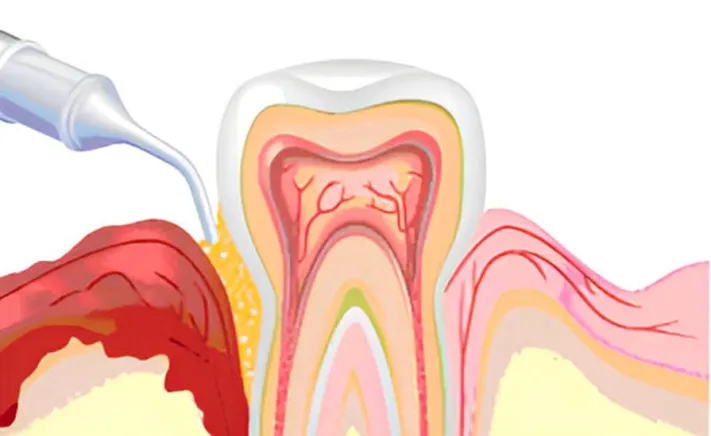 Arestin® Gum Treatment at Copper Hills Dental