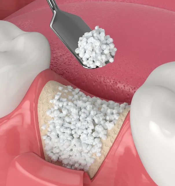 Bone Grafting at Copper Hills Dental