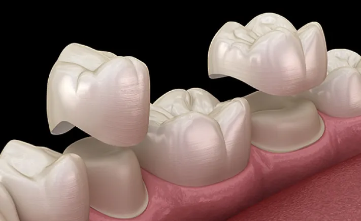 Crown Lengthening at Copper Hills Dental