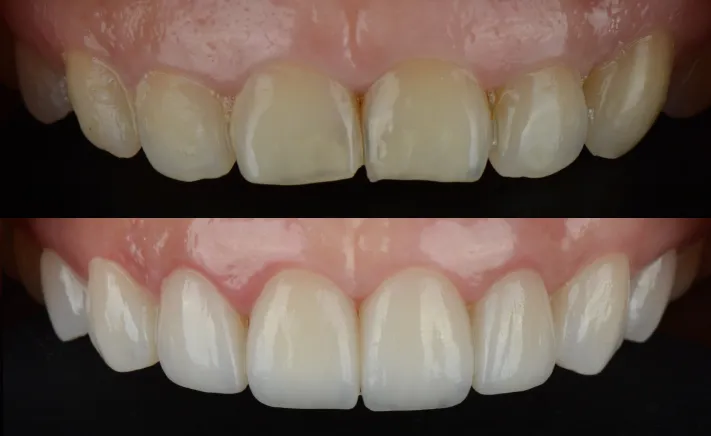 Crown Lengthening at Copper Hills Dental