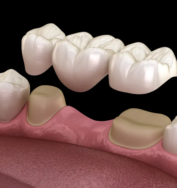 Dental Bridges at Copper Hills Dental