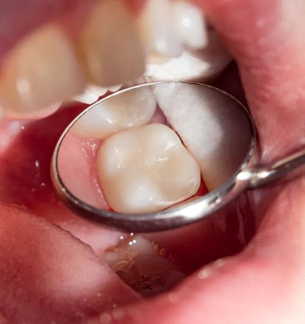 Dental Fillings at Copper Hills Dental