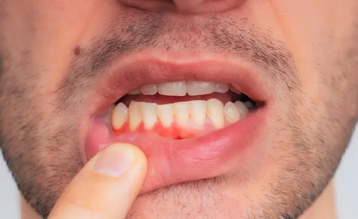 Periodontics at Copper Hills Dental